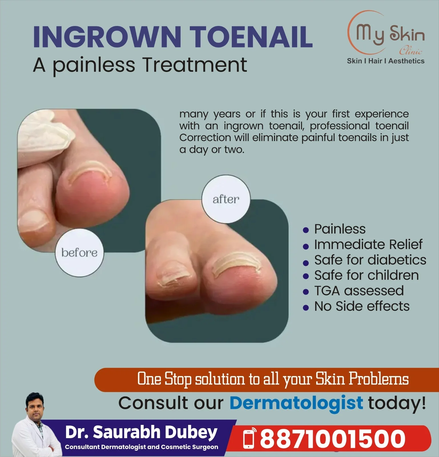 Ingrown Toenail Treatment in Indore